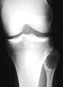 giant cell tumour