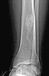 fibroma