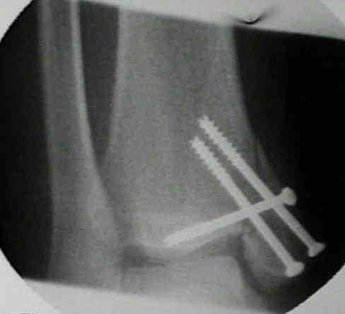 ankle #