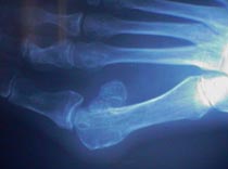 bunion