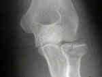 fracture radial head