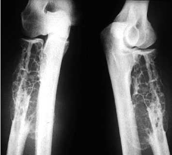 metastatic disease
