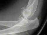 dislocation/fracture