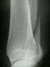 ankle #