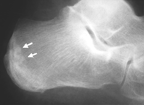 stress fracture