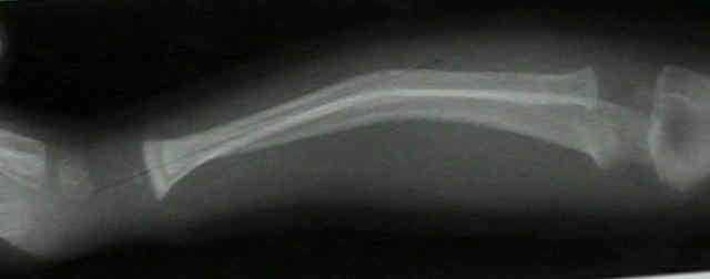 greenstick fracture