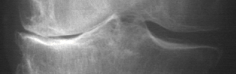OA Knee