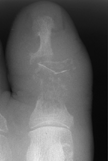 osteomyelytis