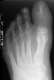 osteomyelytis