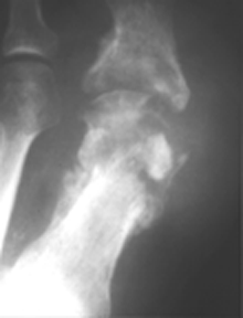 Metatarsal fracture