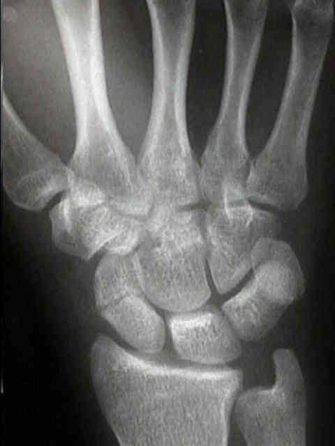 scaphoid #