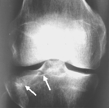 tibial plateau #